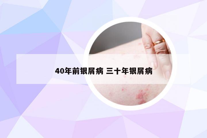 40年前银屑病 三十年银屑病