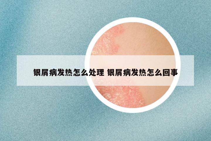 银屑病发热怎么处理 银屑病发热怎么回事