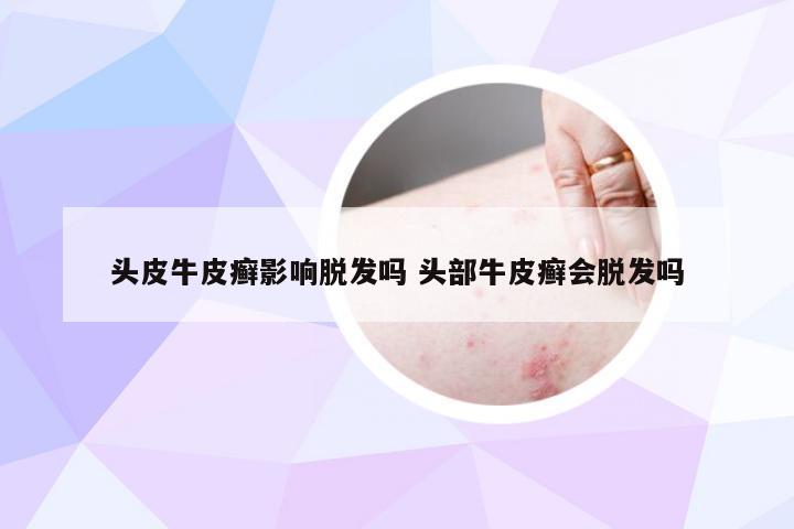 头皮牛皮癣影响脱发吗 头部牛皮癣会脱发吗