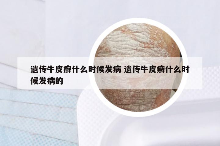 遗传牛皮癣什么时候发病 遗传牛皮癣什么时候发病的