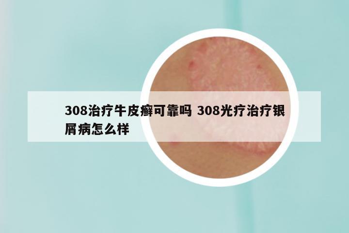 308治疗牛皮癣可靠吗 308光疗治疗银屑病怎么样