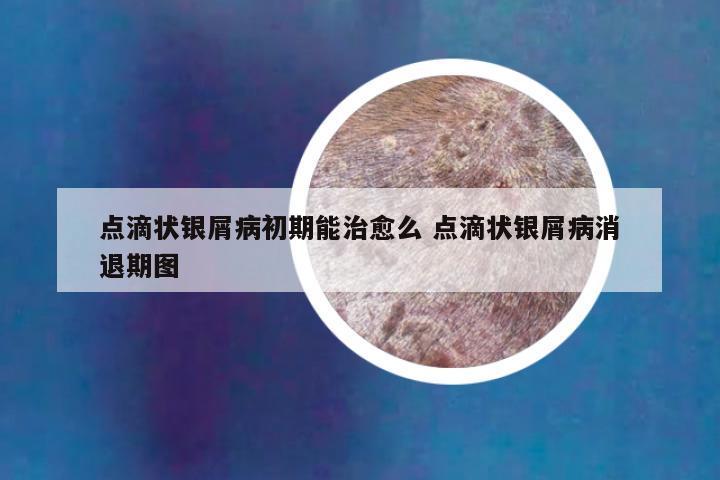 点滴状银屑病初期能治愈么 点滴状银屑病消退期图
