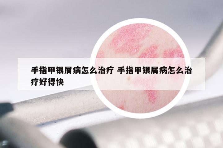 手指甲银屑病怎么治疗 手指甲银屑病怎么治疗好得快