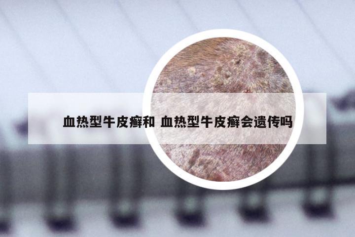 血热型牛皮癣和 血热型牛皮癣会遗传吗