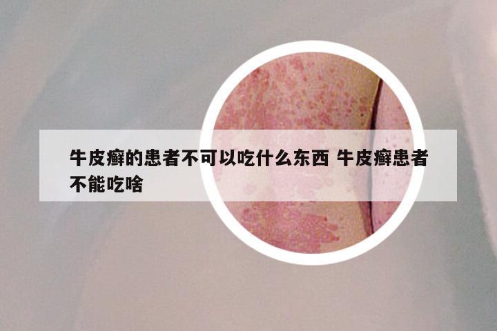 牛皮癣的患者不可以吃什么东西 牛皮癣患者不能吃啥