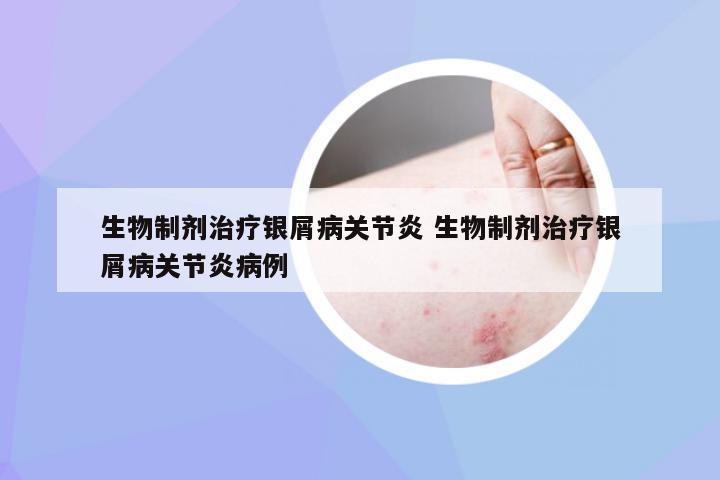 生物制剂治疗银屑病关节炎 生物制剂治疗银屑病关节炎病例