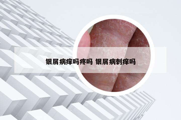 银屑病痒吗疼吗 银屑病刺痒吗