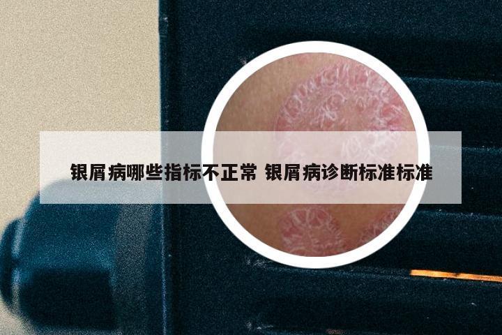 银屑病哪些指标不正常 银屑病诊断标准标准