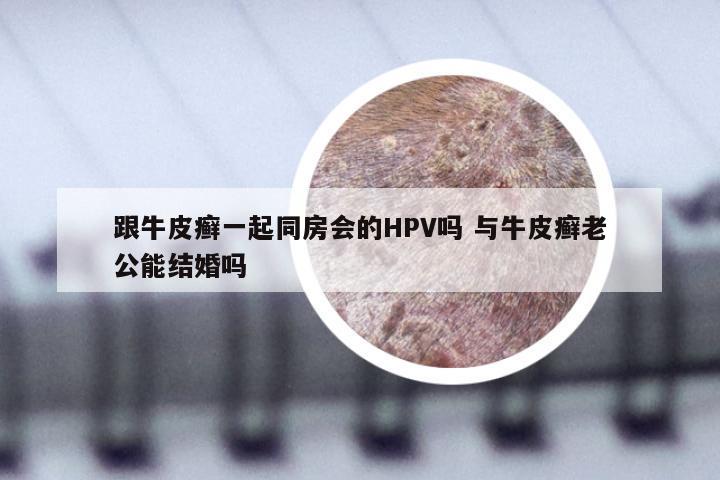 跟牛皮癣一起同房会的HPV吗 与牛皮癣老公能结婚吗