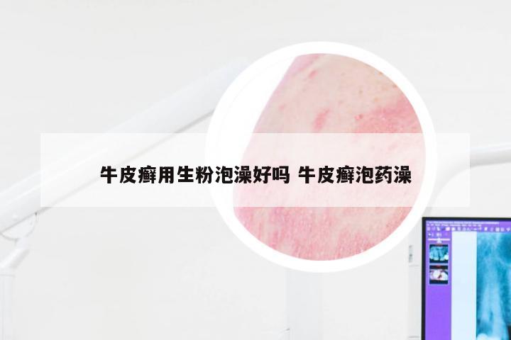 牛皮癣用生粉泡澡好吗 牛皮癣泡药澡