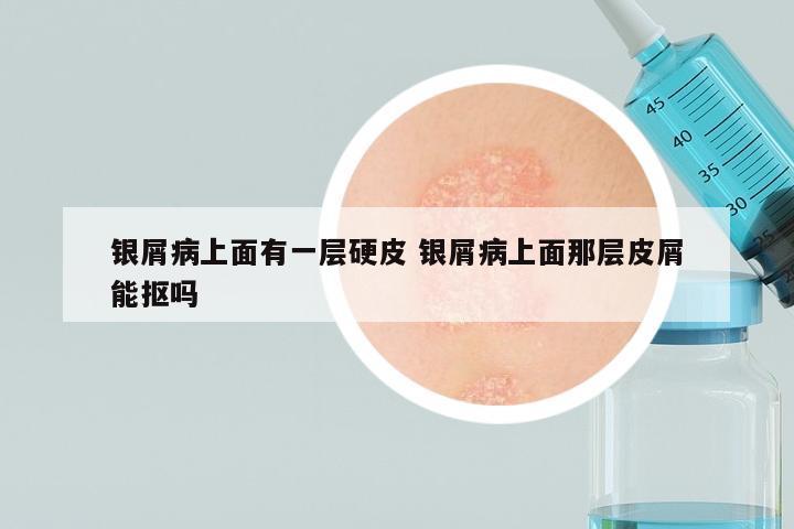 银屑病上面有一层硬皮 银屑病上面那层皮屑能抠吗