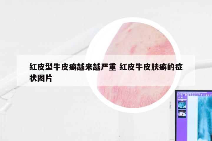 红皮型牛皮癣越来越严重 红皮牛皮肤癣的症状图片