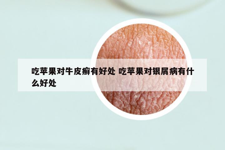 吃苹果对牛皮癣有好处 吃苹果对银屑病有什么好处