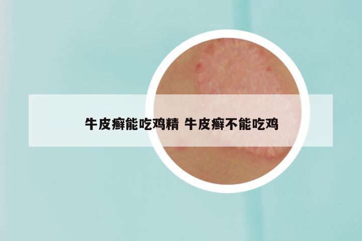 牛皮癣能吃鸡精 牛皮癣不能吃鸡