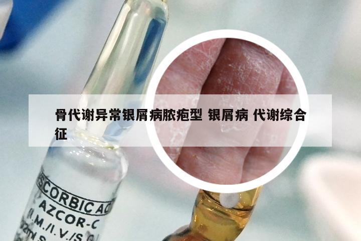 骨代谢异常银屑病脓疱型 银屑病 代谢综合征