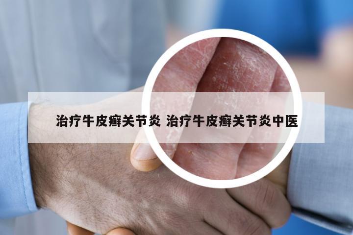 治疗牛皮癣关节炎 治疗牛皮癣关节炎中医