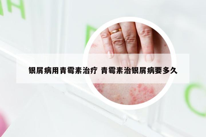 银屑病用青霉素治疗 青霉素治银屑病要多久