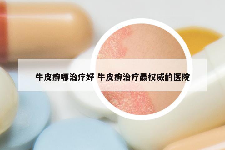 牛皮癣哪治疗好 牛皮癣治疗最权威的医院