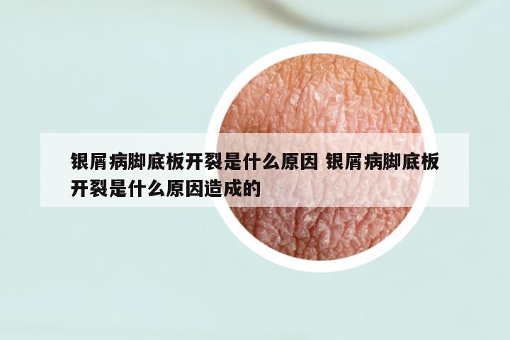 银屑病脚底板开裂是什么原因 银屑病脚底板开裂是什么原因造成的