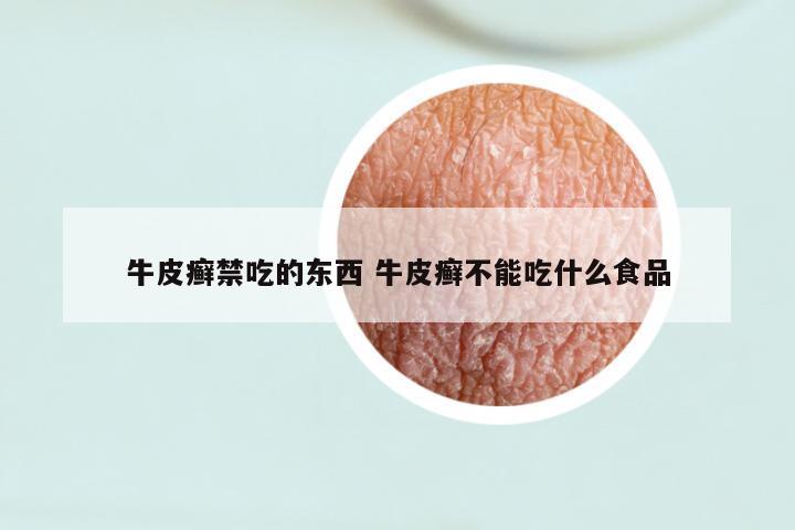 牛皮癣禁吃的东西 牛皮癣不能吃什么食品