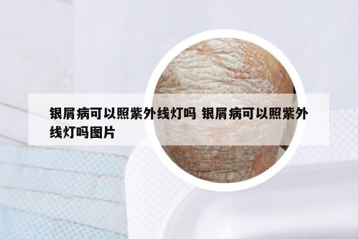 银屑病可以照紫外线灯吗 银屑病可以照紫外线灯吗图片