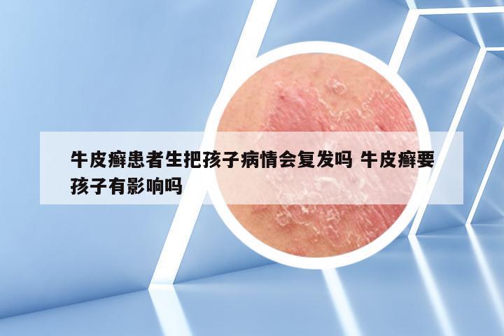 牛皮癣患者生把孩子病情会复发吗 牛皮癣要孩子有影响吗