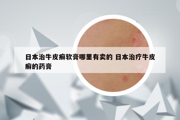 日本治牛皮癣软膏哪里有卖的 日本治疗牛皮癣的药膏