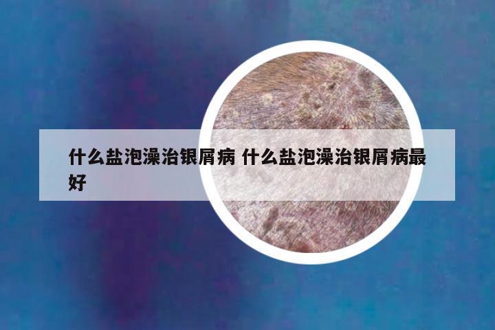 什么盐泡澡治银屑病 什么盐泡澡治银屑病最好