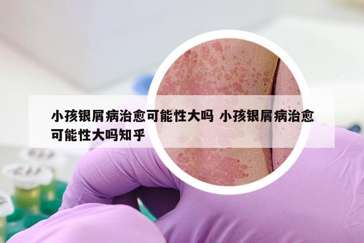 小孩银屑病治愈可能性大吗 小孩银屑病治愈可能性大吗知乎