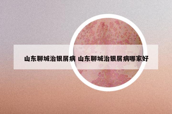 山东聊城治银屑病 山东聊城治银屑病哪家好