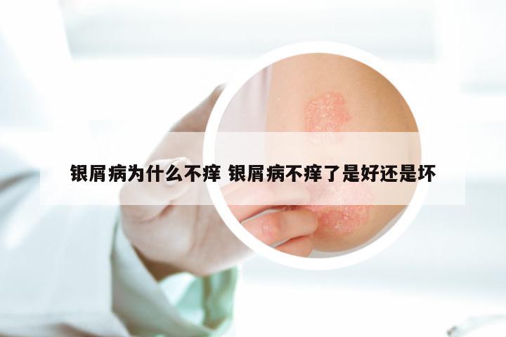 银屑病为什么不痒 银屑病不痒了是好还是坏