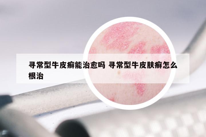 寻常型牛皮癣能治愈吗 寻常型牛皮肤癣怎么根治