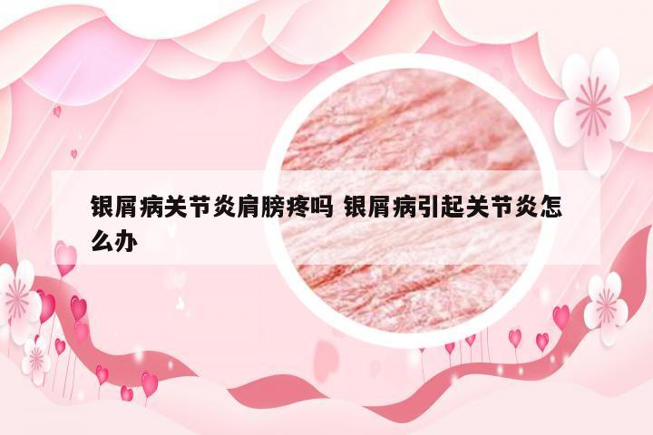 银屑病关节炎肩膀疼吗 银屑病引起关节炎怎么办