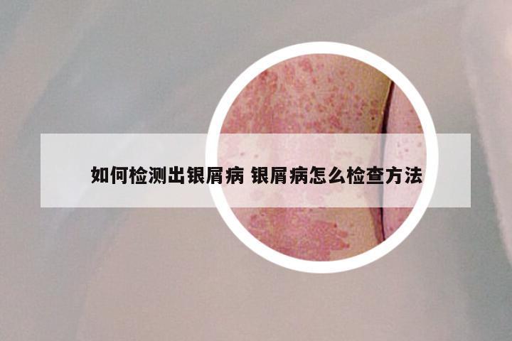 如何检测出银屑病 银屑病怎么检查方法