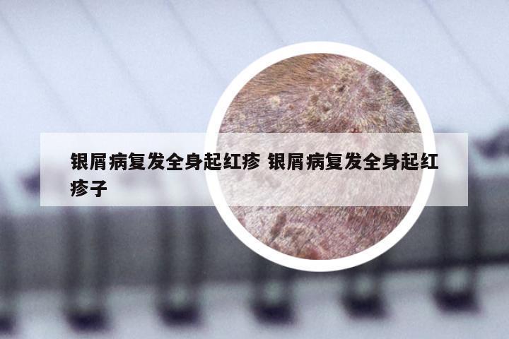 银屑病复发全身起红疹 银屑病复发全身起红疹子