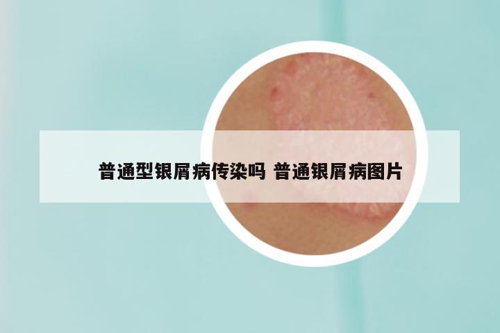 普通型银屑病传染吗 普通银屑病图片