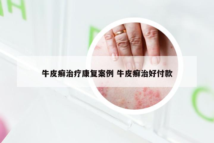 牛皮癣治疗康复案例 牛皮癣治好付款