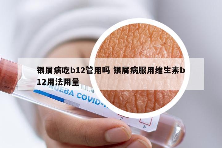 银屑病吃b12管用吗 银屑病服用维生素b12用法用量