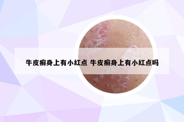 牛皮癣身上有小红点 牛皮癣身上有小红点吗