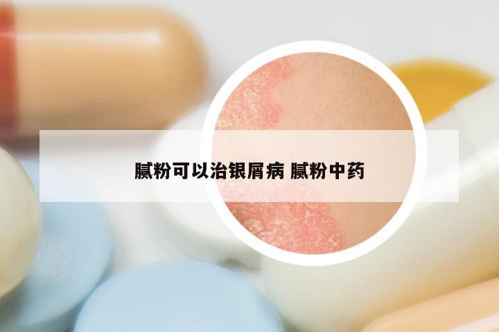 腻粉可以治银屑病 腻粉中药