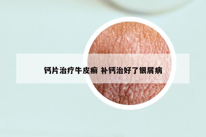 钙片治疗牛皮癣 补钙治好了银屑病