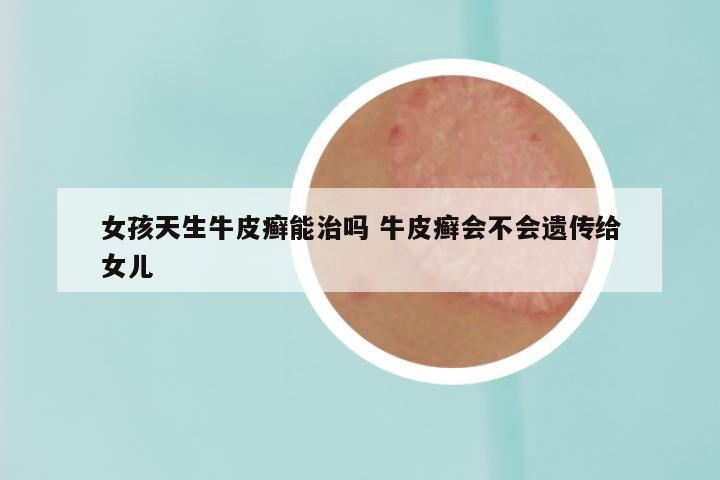 女孩天生牛皮癣能治吗 牛皮癣会不会遗传给女儿