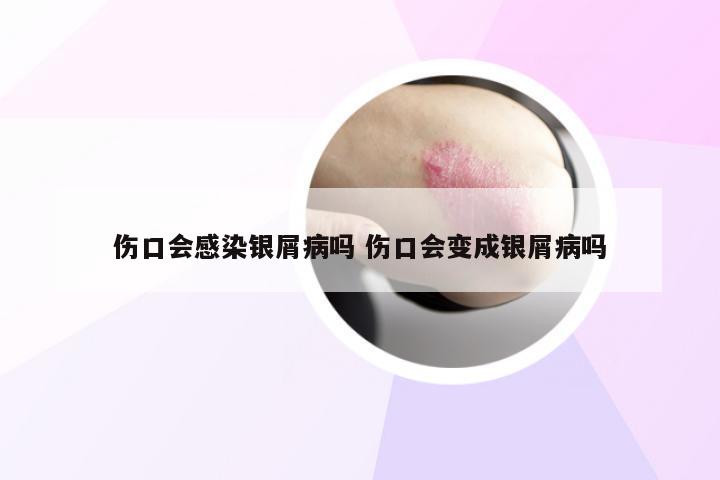 伤口会感染银屑病吗 伤口会变成银屑病吗