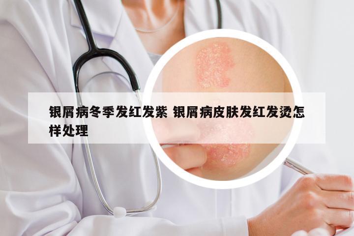 银屑病冬季发红发紫 银屑病皮肤发红发烫怎样处理