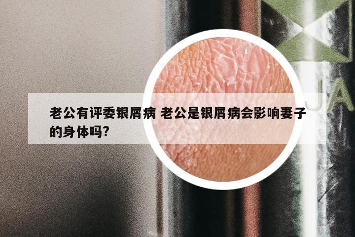 老公有评委银屑病 老公是银屑病会影响妻子的身体吗?