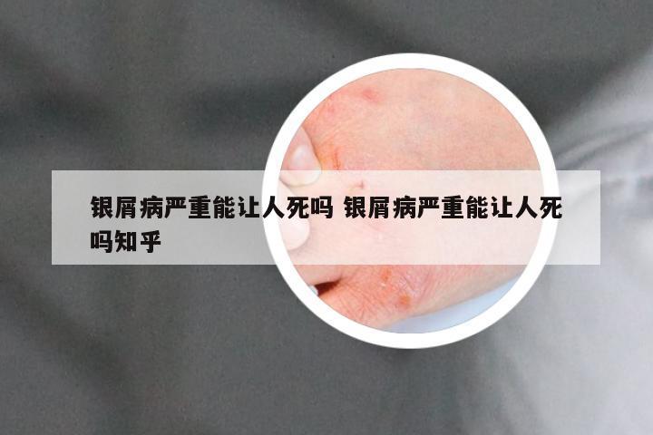 银屑病严重能让人死吗 银屑病严重能让人死吗知乎
