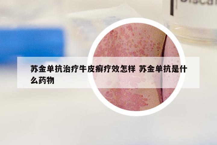 苏金单抗治疗牛皮癣疗效怎样 苏金单抗是什么药物