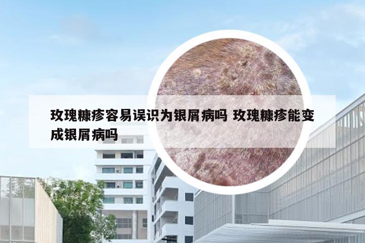 玫瑰糠疹容易误识为银屑病吗 玫瑰糠疹能变成银屑病吗