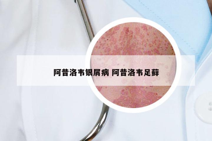 阿昔洛韦银屑病 阿昔洛韦足藓