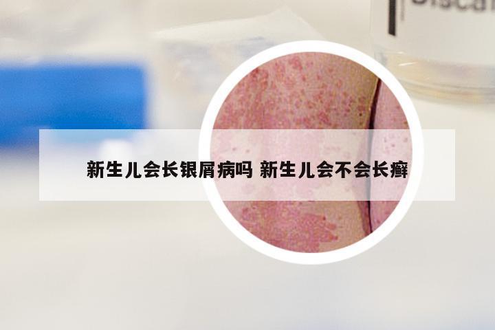 新生儿会长银屑病吗 新生儿会不会长癣